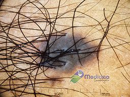 quitar lunar cirugia laser quitar lunares precio Guadalajara Jalisco México