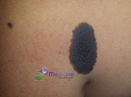 cirugia laser quitar lunares precio Guadalajara Jalisco México