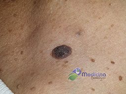 cirugia laser lunares precio Guadalajara Jalisco México