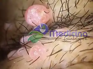 Dermatologo en Guadalajara ESPECIALISTA EN MOLUSCO CONTAGIOSO y PAPILOMA HUMANO Guadalajara jalisco Mexico