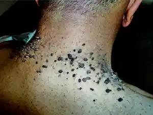 cuanto cuesta Quitar verrugas en Guadalajara Jalisco Mexico