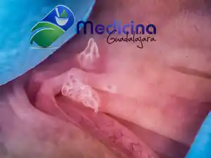 Costo eliminar verrugas genitales