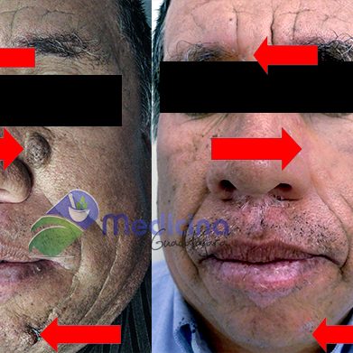 costo quitar lunares y mezquinos Guadalajara Jalisco México