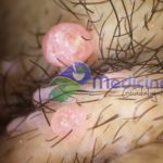 Dermatólogo en Guadalajara Verrugas, Lunares, Mezquinos, Virus Papiloma Humano - Dr Guillermo Valdés González Guadalajara Jalisco México Teléfonos: +(33) 36143683 / +(33) 18129319